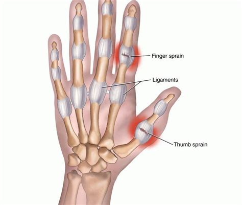 Thumb Sprain: Symptoms & Treatment