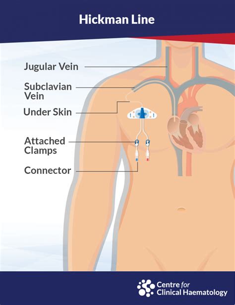 Hickman Line Insertion | CFCH | Centre for Clinical Haematology