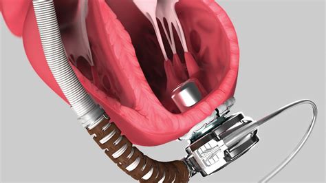 Medical Device Animation: Heartware System LVAD Pump | Medical, Cognitive, Cardiothoracic surgery