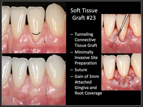 Gingival Graft Before And After