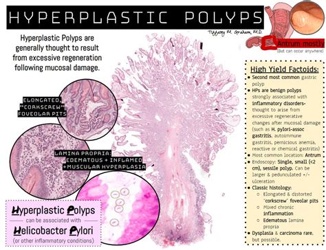 Gastric polyps- The Hyperplastic Polyp (HP)