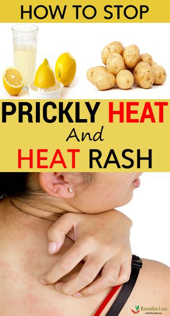 How To Stop Prickly Heat And Heat Rash - Remedies Lore