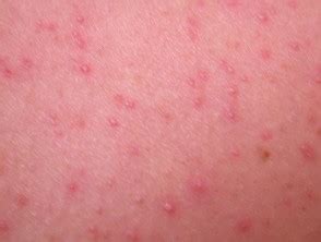 Malassezia folliculitis | DermNet NZ