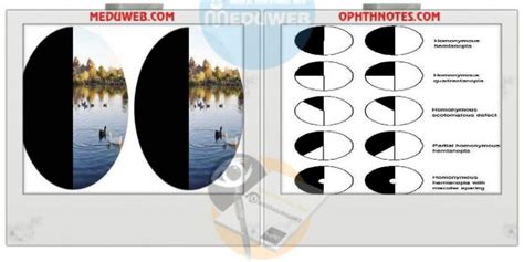 Cortical Blindness - Meduweb