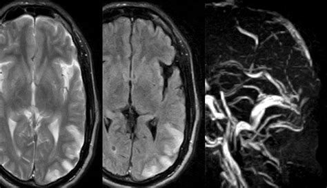 Superior Sagittal Thrombosis-MRI - Sumer's Radiology Blog