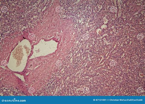 Human Spleen with Chronic Myelogenous Leukemia Stock Image - Image of carcinoma, physiology ...