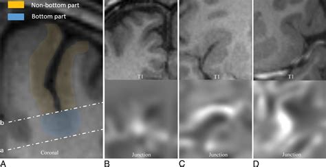 MRI Abnormalities Predominate in the Bottom Part of the Sulcus with ...