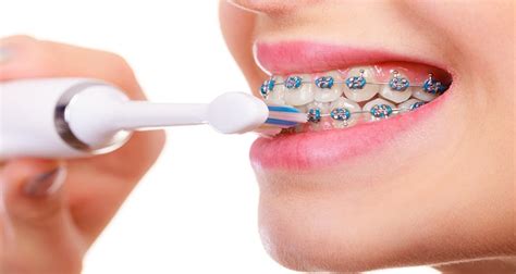 Top 9 Electric Toothbrushes For Braces In 2024