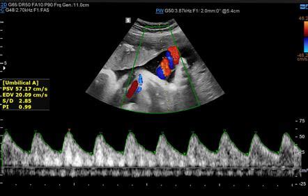 Umbilical Artery Doppler