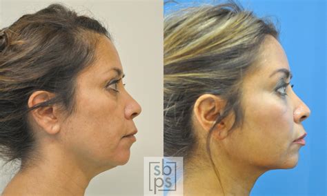 Face Liposuction Before And After