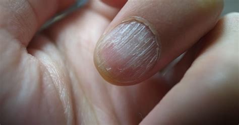 Three Ways How to Fix a Vertical Split Nail: Quick Tips – DTK Nail Supply