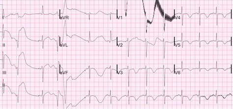 Dr. Smith's ECG Blog: Long QT Syndrome with Continuously Recurrent Polymorphic VT: Management