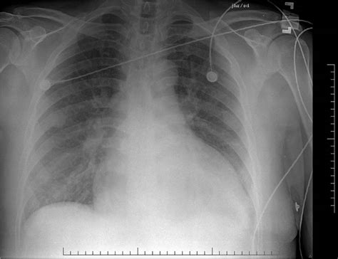 Pulmonary Edema Chest X Ray