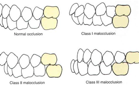 Do you know what occlusion class you have?