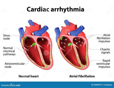 Cardiac arrhythmia stock vector. Illustration of coronary - 64089813