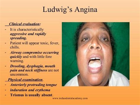 Ludwig angina gs mouth | Oral pathology, Medical, Dermatology