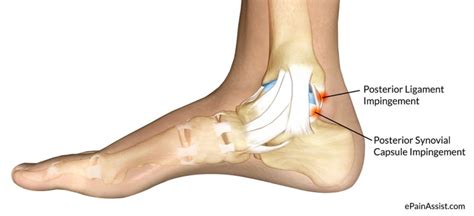 Posterior Ankle Impingement: Overview and Treatment - Capital Area PT ...