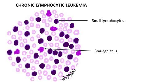 Peripheral smear findings in Leukemia - Illustrated - Pathology Made Simple