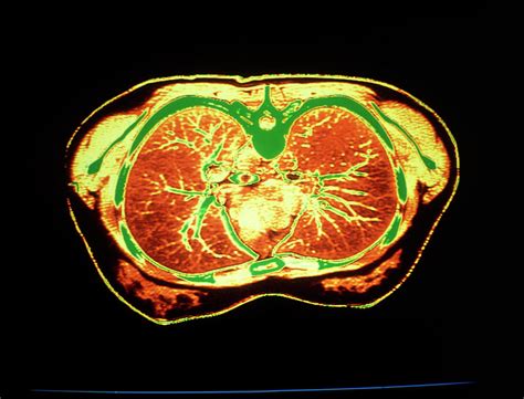 Ct Scan Showing Normal Lungs Photograph by Simon Fraser/science Photo Library - Pixels