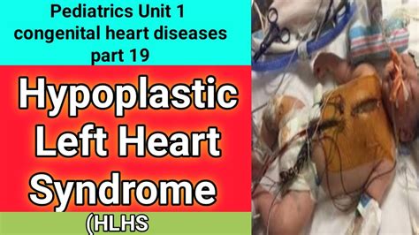 hypoplastic left heart syndrome | hlhs | congenital heart diseases ...