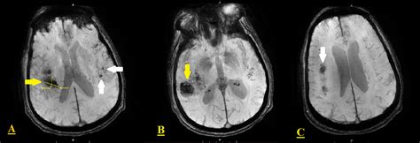 Cureus | Primary Central Nervous System Vasculitis as an Unusual Cause ...