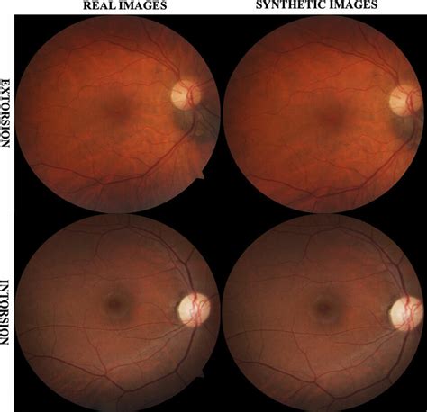 Comparison of real versus synthetic torsional data for right eye ...