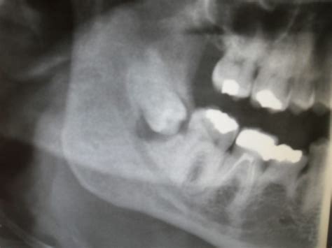 Third Molar Guidelines | Orofacial Pain