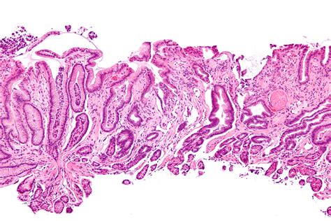 Stomach Hemorrhage Symptoms - kalamesblog