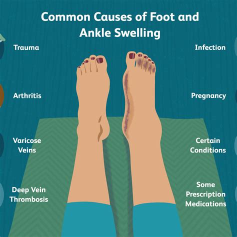 View 24 Preeclampsia Swelling Vs Normal Swelling - characterizequoteqjibril