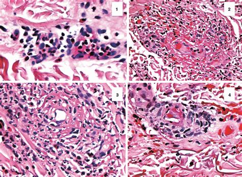 Urticarial Vasculitis Histology