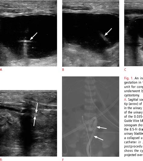 Figure 1 from Bedside ultrasound-guided percutaneous cystostomy in an infant in the neonatal ...