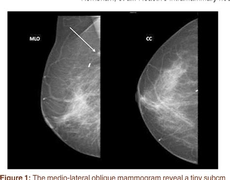 Figure 1 from Reactive intramammary lymph node mimicking recurrence on MRI study in a patient ...