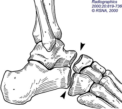 Calcaneocuboid Dislocation