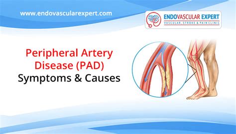 Peripheral artery disease: symptoms and causes | EndovasculaExpert