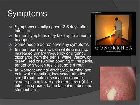 Gonorrhea Mouth Symptoms