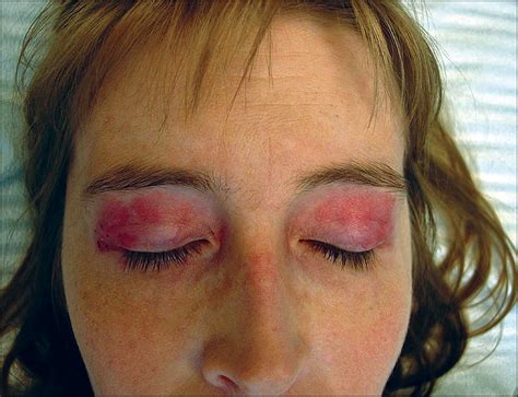 A 38-Year-Old Woman With Eyelid Discoloration—Quiz Case | Dermatology ...