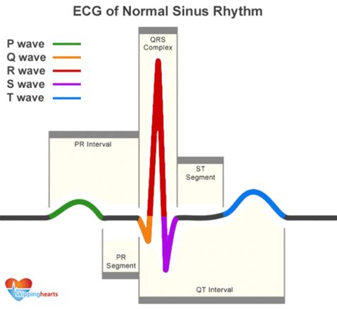 ECG Rhythms | Pr interval, Cardiac nursing, Sinus rhythm