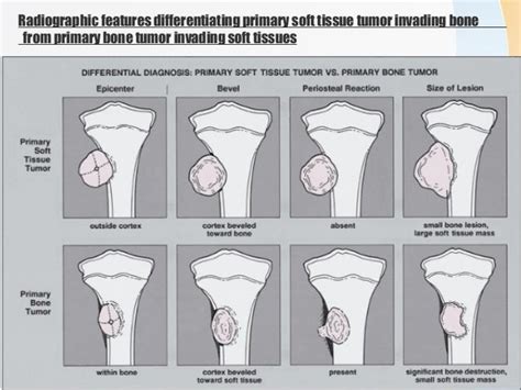 An approach to malignant bone tumors