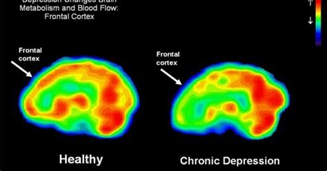 Let's TALK about Genoism: Normal Brain vs. Depression Brain