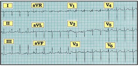 ECG Interpretation: ECG Interpretation Review #77 (Chamber Enlargement ...