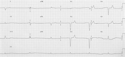 Hyperkalaemia ECG changes • LITFL • ECG Library