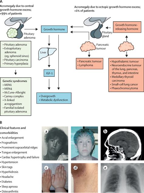 Acromegaly Pathogenesis Diagnosis And Management The Lancet | The Best ...