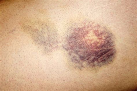 Purpura: Causes, Types, and Symptoms