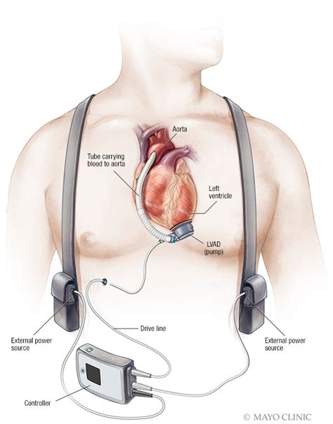 Ventricular assist device (VAD) - Mayo Clinic