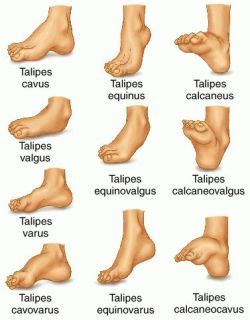 Congenital Talipes Equinovarus (Clubfoot) Nursing Care Management - Nurseslabs