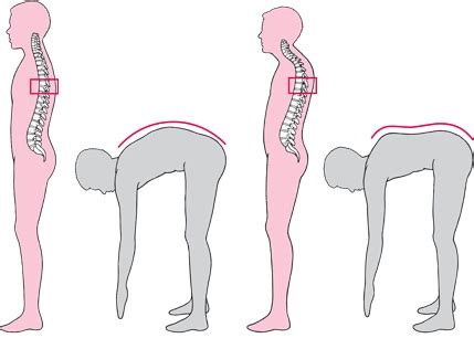 Kyphosis Treatment - Hudson Valley Scoliosis