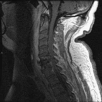 Spinal Epidural Abscess | Neupsy Key