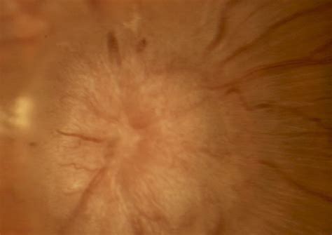 Papilledema Grades. EyeRounds.org - Ophthalmology - The University of Iowa