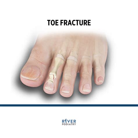 Toe Fractures — River Podiatry I The Best Foot and Ankle Care in NY/NJ