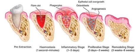 Typical Teeth Post-extraction Healing Stages : r/wisdomteeth